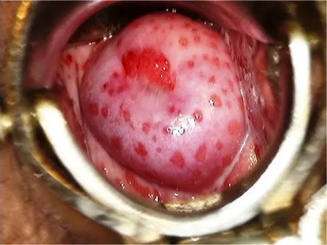 Colpite Macular típica da Tricomoníase Cérvice em Framboesa