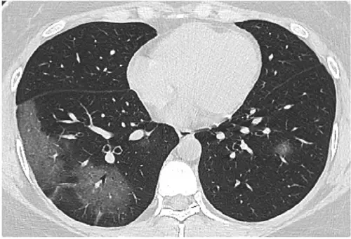 Infiltrado Pulmonar em Vidro Fosco
