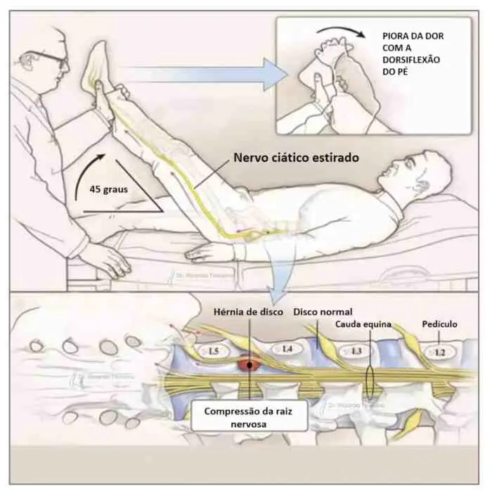 Manobra de Lasègue para pesquisa de radiculopatia Sinal de Lasègue
