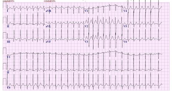 Eletrocardiograma