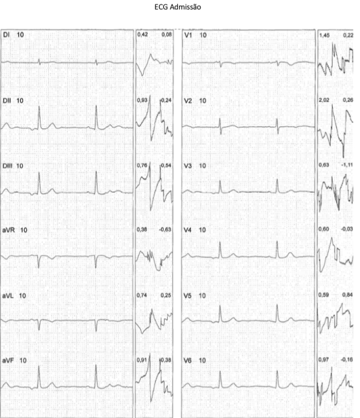 ECG Admissão