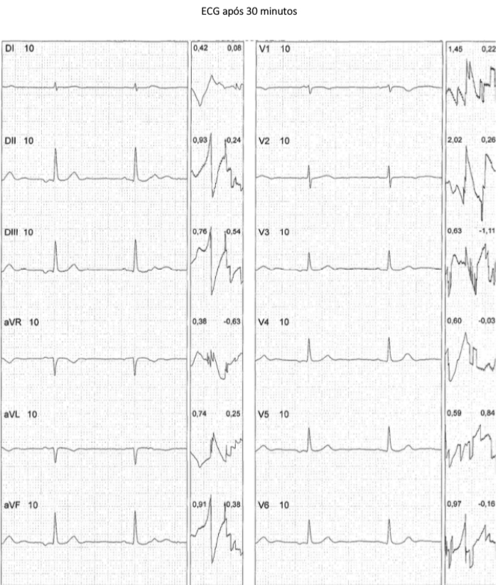 ECG após 30 minutos