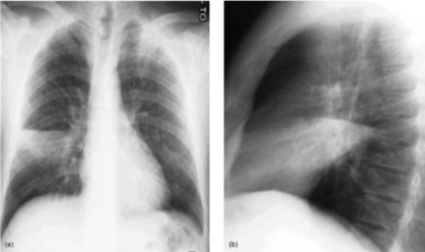 Radiografia de Tórax Q60