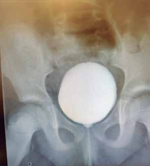 Uretrocistografia miccional - imagem 1