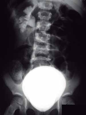 Uretrocistografia miccional - imagem 2
