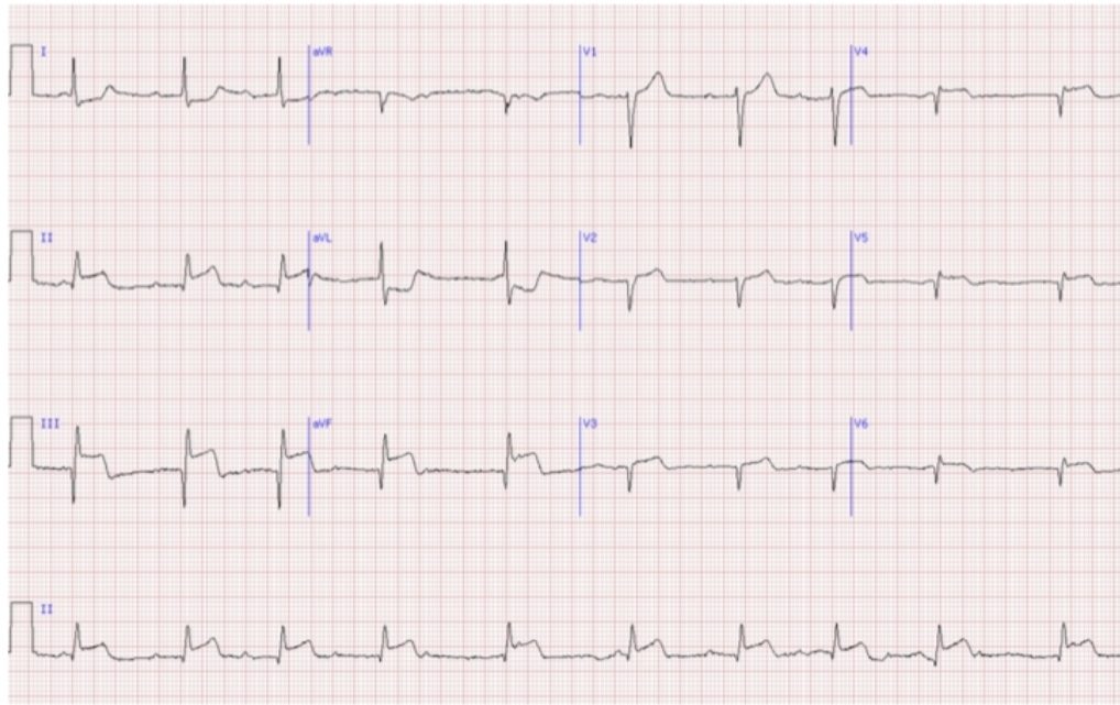 Eletrocardiograma